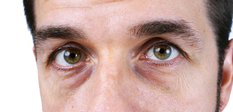 reduce dark circles under eyes